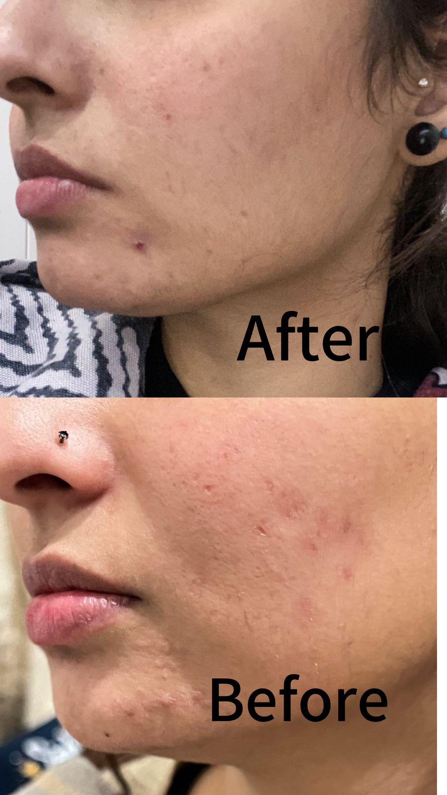 Acne Control Treatment - 2 % Salicylic acid - GlowNestpk.com