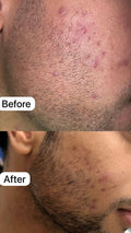 Acne Control Treatment - 2 % Salicylic acid - GlowNestpk.com