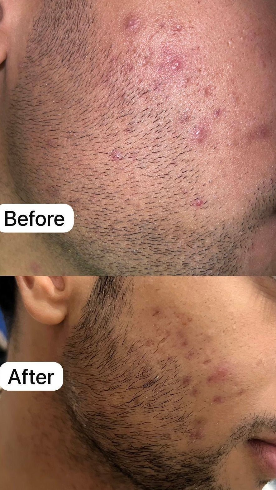 Acne Control Treatment - 2 % Salicylic acid - GlowNestpk.com