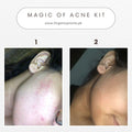Acno Fight Mist – Anti Acne Toner - GlowNestpk.com