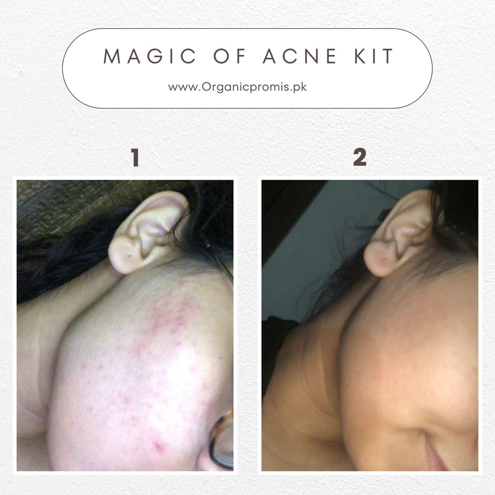 Acno Fight Mist – Anti Acne Toner - GlowNestpk.com
